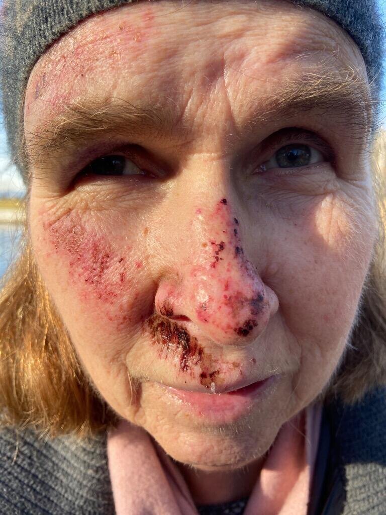 Privat bilde etter fall.