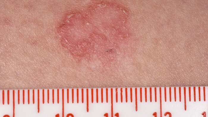 Bildet viser hud med infisert lesjon.