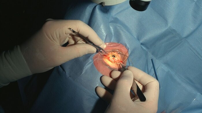 Bildet viser en grå stær-operasjon