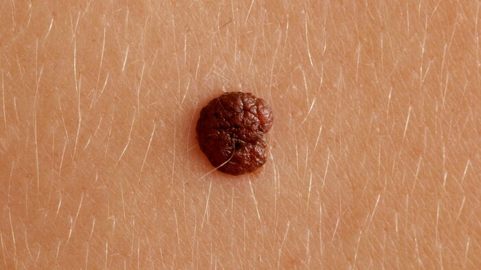 Nærbilde av føflekk