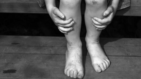 Illustrasjonsbilde av barn som er skadet.