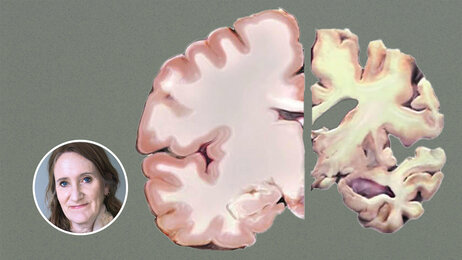 Bildet viser en frisk hjernehalvdel og en med alzheimers sykdom. 