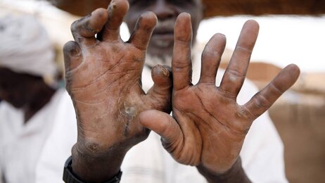 En eldre mann viser frem hender rammet av lepra.