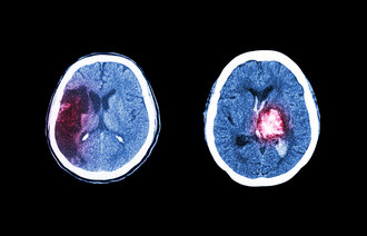 Bildet viser en CT-skanning av hjerneslag på grunn av cerebralt infarkt og blodpropp