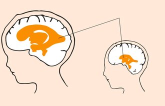 VANNHODE: Hydrocephalus (vannhode) er en tilstand med økt hjernevæske og utvidelse av hjernens naturlige hulrom, ventrikkelsystemet. Kilde: Oslo-universitetssykehus. Illustrasjon: Monica Hilsen