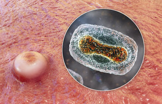 Bildet viser apekoppe-lesjon og innfelt virus.