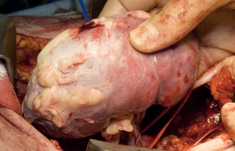Bilde viser transplantasjon av nyre
