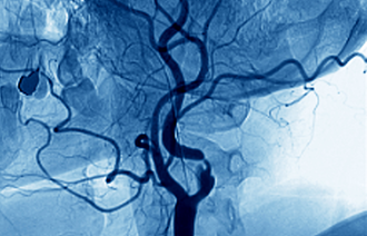 Bildet viser et angiogram av en innsnevret arterie i nakken.