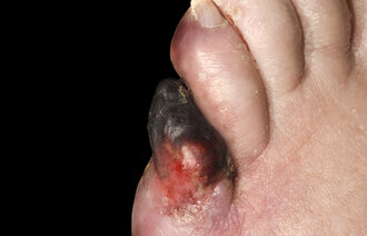 Bildet viser tåa til en person med diabetes. Tåa er svart og rød.