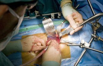 Bildet viser en nyretransplantasjon