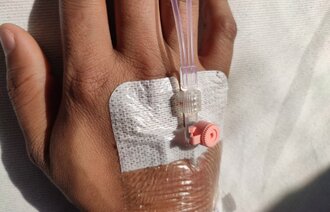 Bildet viser et PVK (perifert venekateter) i hånden