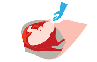 Illustrasjonen viser kvinne i fødsel