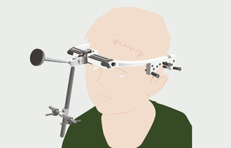 Illustrasjonen viser behandling for kraniofacial synostose