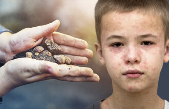 Bildet viser et par barnehender som holder noe jord og sand. Til høyre i bildet er ansiktet til en gutt som har meslinger