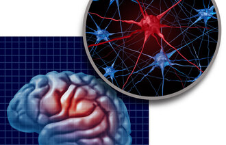 Bildet viser en illustrasjon av en hjerne med Parkinson sykdom