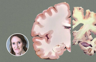 Bildet viser en frisk hjernehalvdel og en med alzheimers sykdom. 