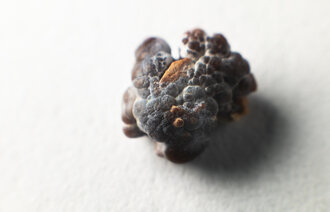 bilde av en nyrestein