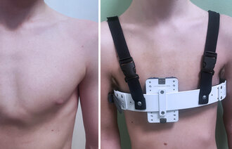 Bildet viser korsettbehandling ved pectus carinatum