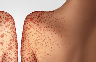 Bildet er en illustrasjon av meslinger som spres fra kropp til kropp