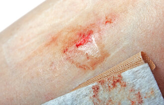 bildet viser et sår