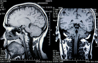 Røntgenbilde av hodeskalle