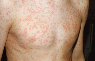 Barn som har meslinger