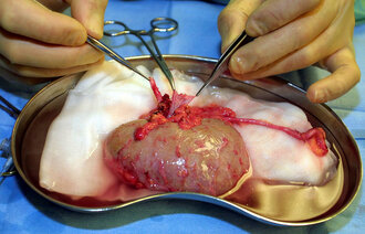 Bildet viser en nyre som er blitt operert ut av en mann. Nyren ligger på et fat, og to hender med instrumenter og saks arbeider.