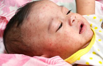 Nærbilde av lite barn som har meslinger