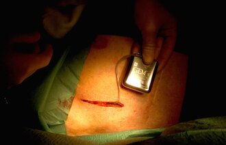 Bildet viser en pasient som får operert inn en hjertestarter