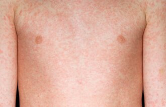 Bildet viser et barn med meslinger