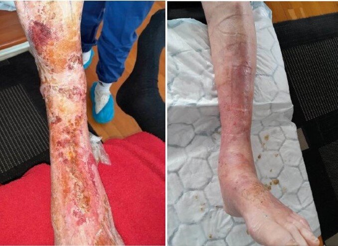 bildet viser leggsår før og etter behandling