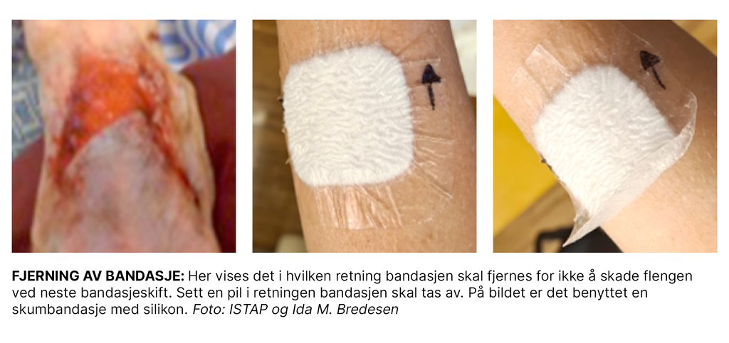 Bildet viser fjerning av bandasje