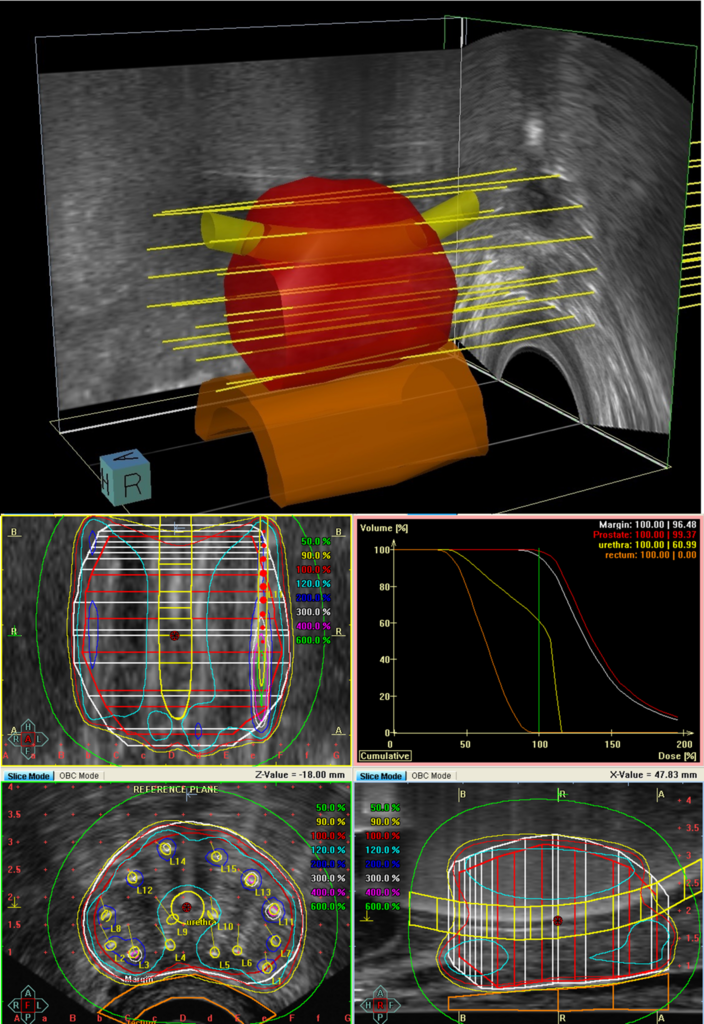 Ultralydbilde av prostata ved brakyterapi