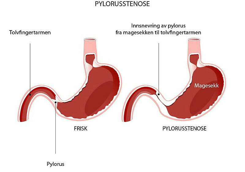Illustrasjonen viser en frisk magesekk ved siden av en med pylorusstenose, en innsnevring av magesekken der den leder ut til tolvfingertarmen