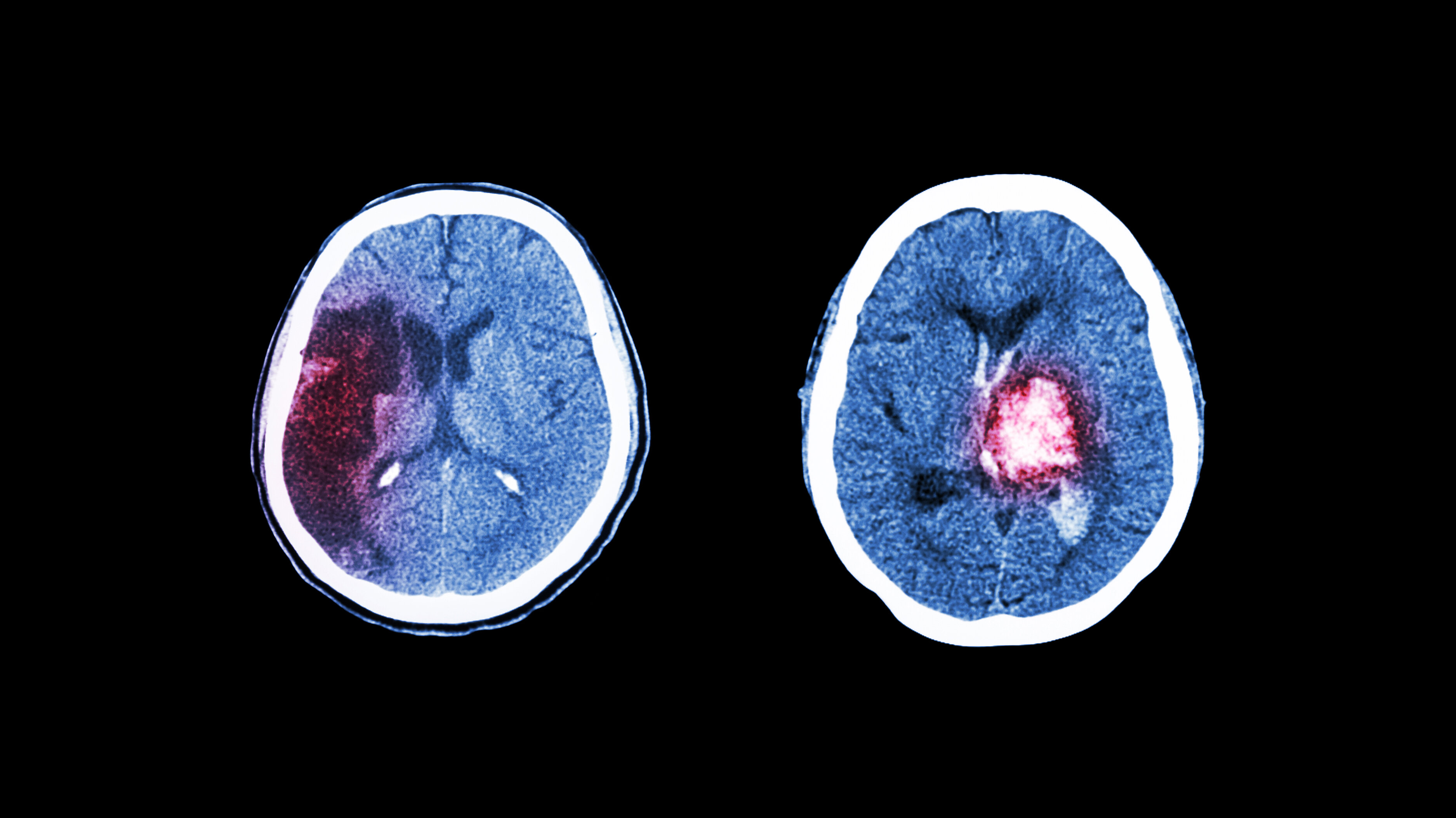 Bildet viser en CT-skanning av hjerneslag på grunn av cerebralt infarkt og blodpropp