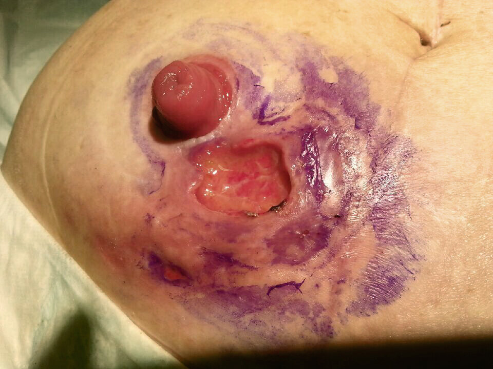Sår ved stomi 