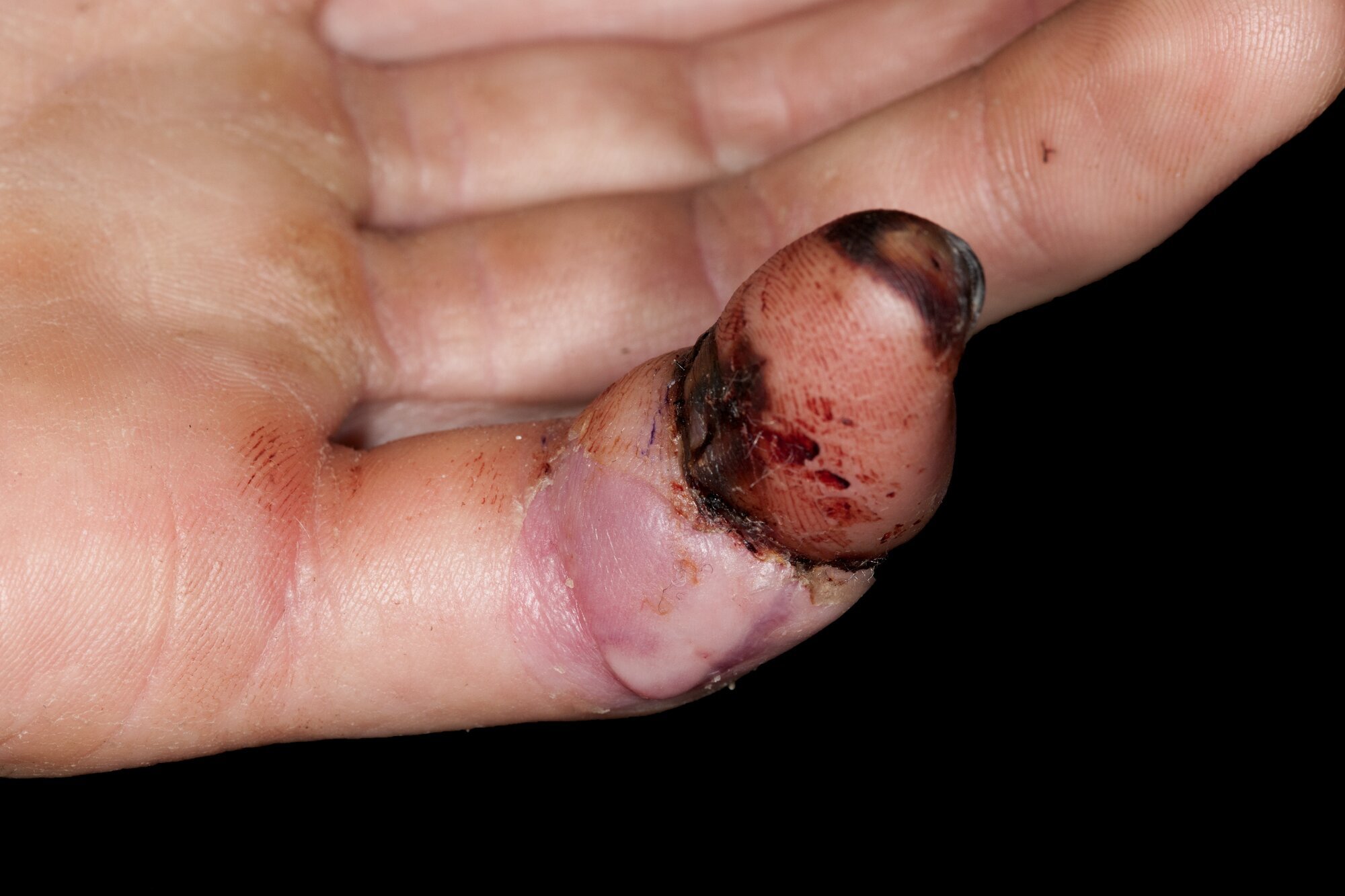 Replantert lillefinger