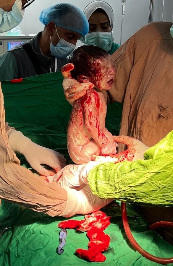 Bildet viser baby etter keisersnitt.