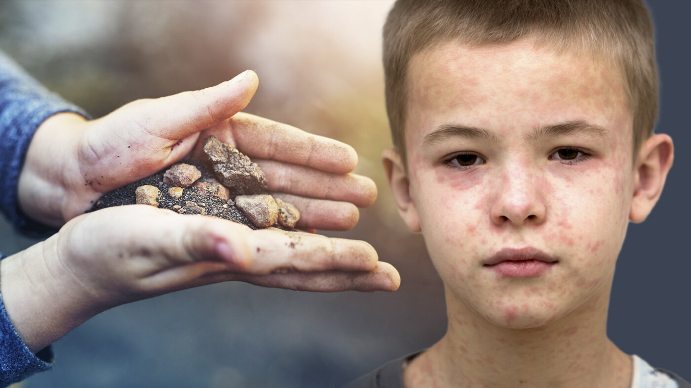 Bildet viser et par barnehender som holder noe jord og sand. Til høyre i bildet er ansiktet til en gutt som har meslinger