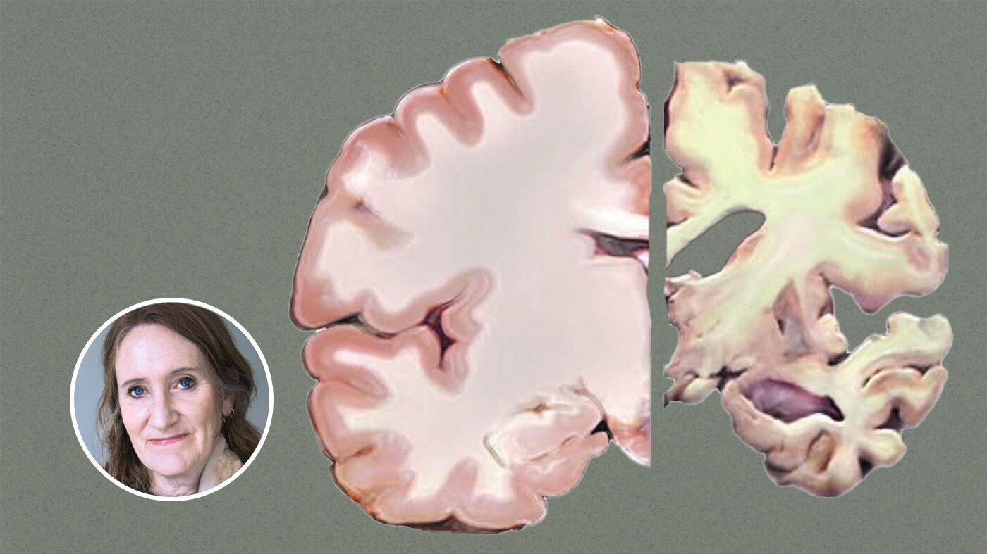 Bildet viser en frisk hjernehalvdel og en med alzheimers sykdom. 