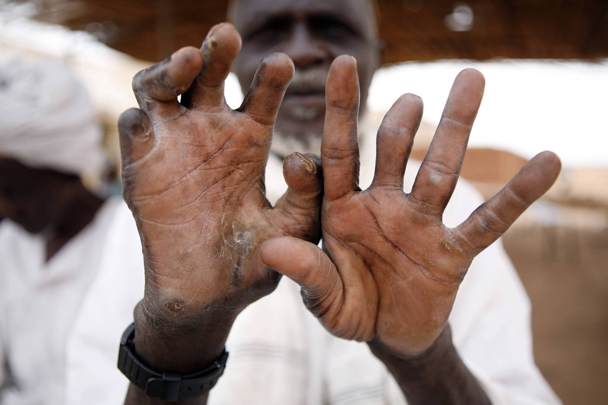 En eldre mann viser frem hender rammet av lepra.