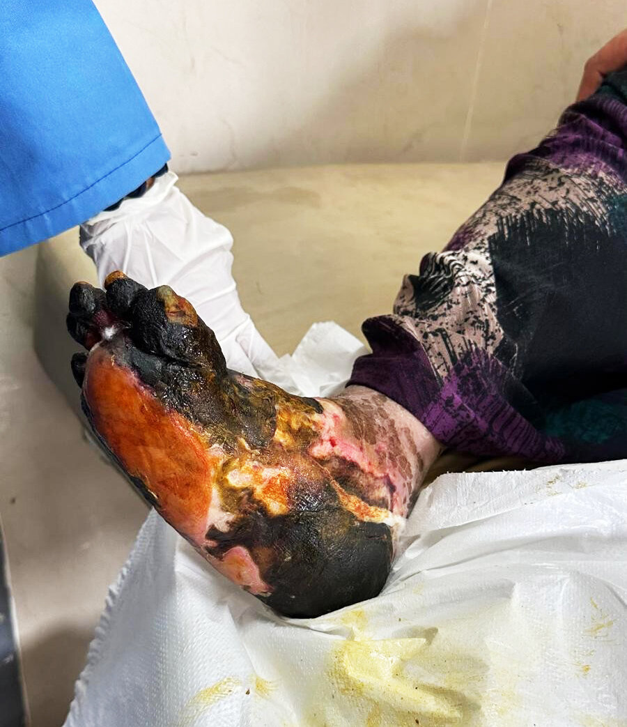 Bildet viser fot med diabetessår