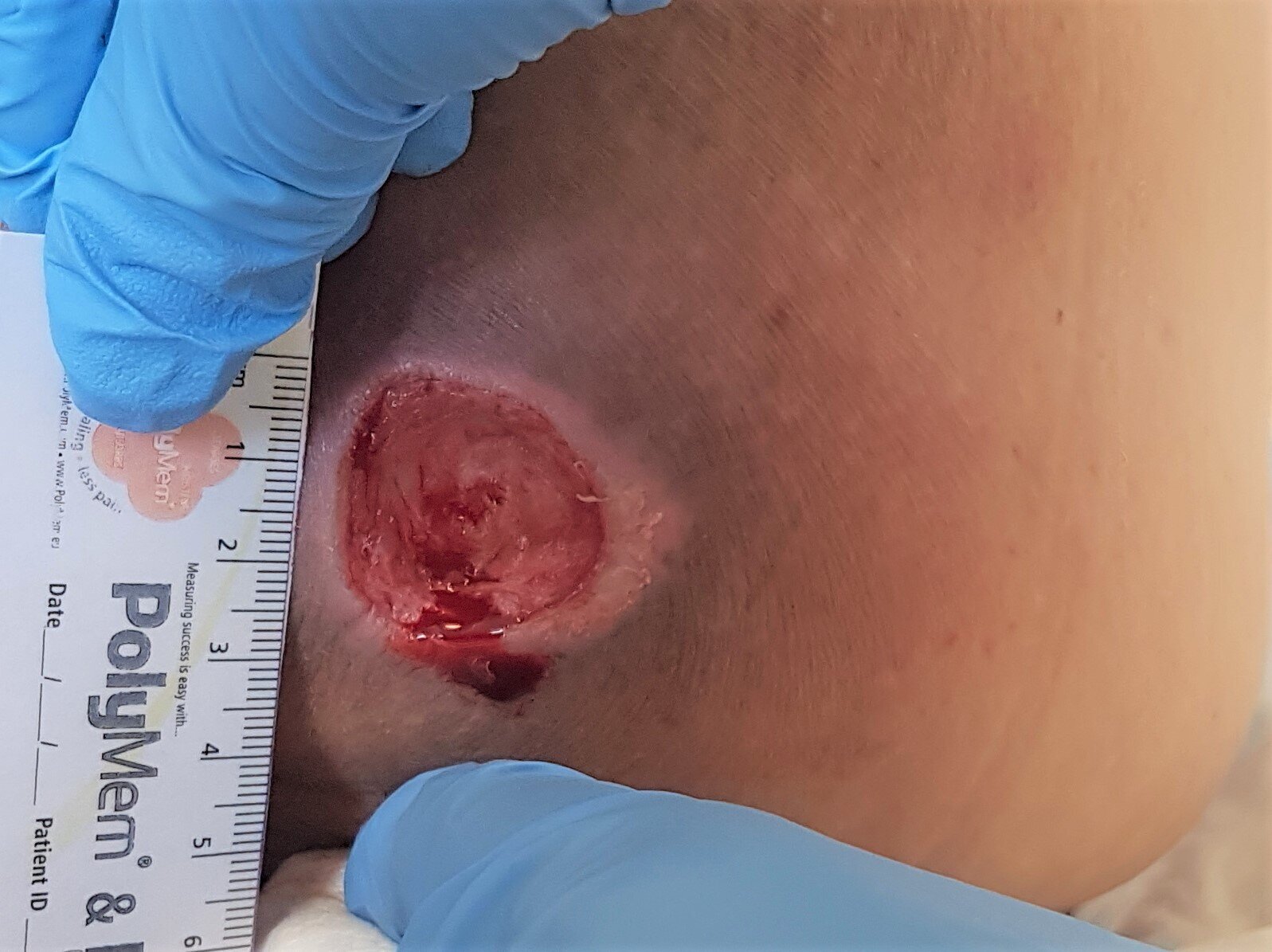 Bildet viser trykksår