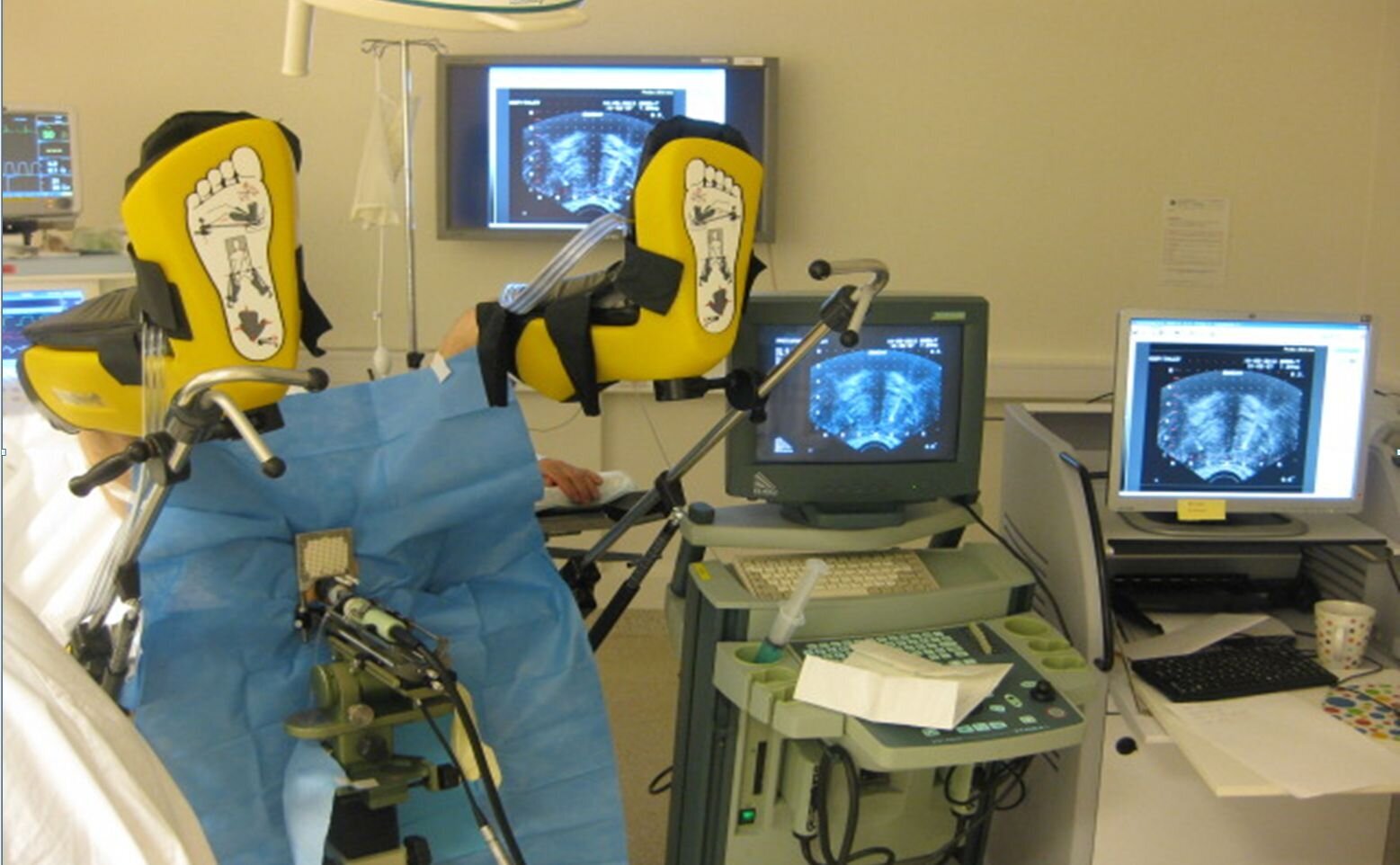 Pasient som gjennomgår brakyterapi