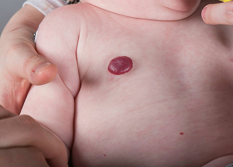 Bilde av hemangiom som av utseende kan minne om et jordbær.