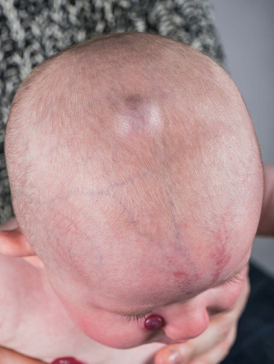 Hemangiom av dypereliggende type.