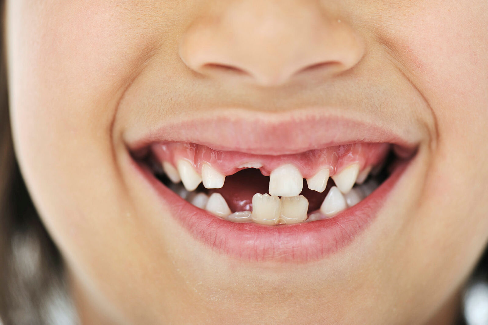 Bildet viser tanngarden til en ung gutt eller jente som har mistet noen av fortennene.