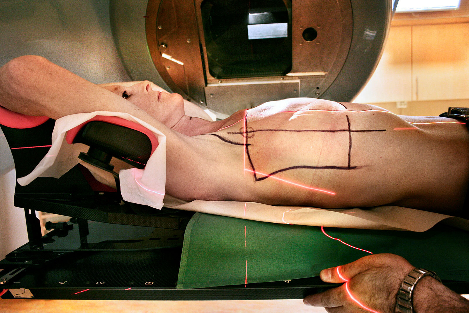 Bildet viser forberedelser før strålebehandling. Vi ser en kvinne som ligger, og som har blitt markert der hvor hun skal bli bestrålt.