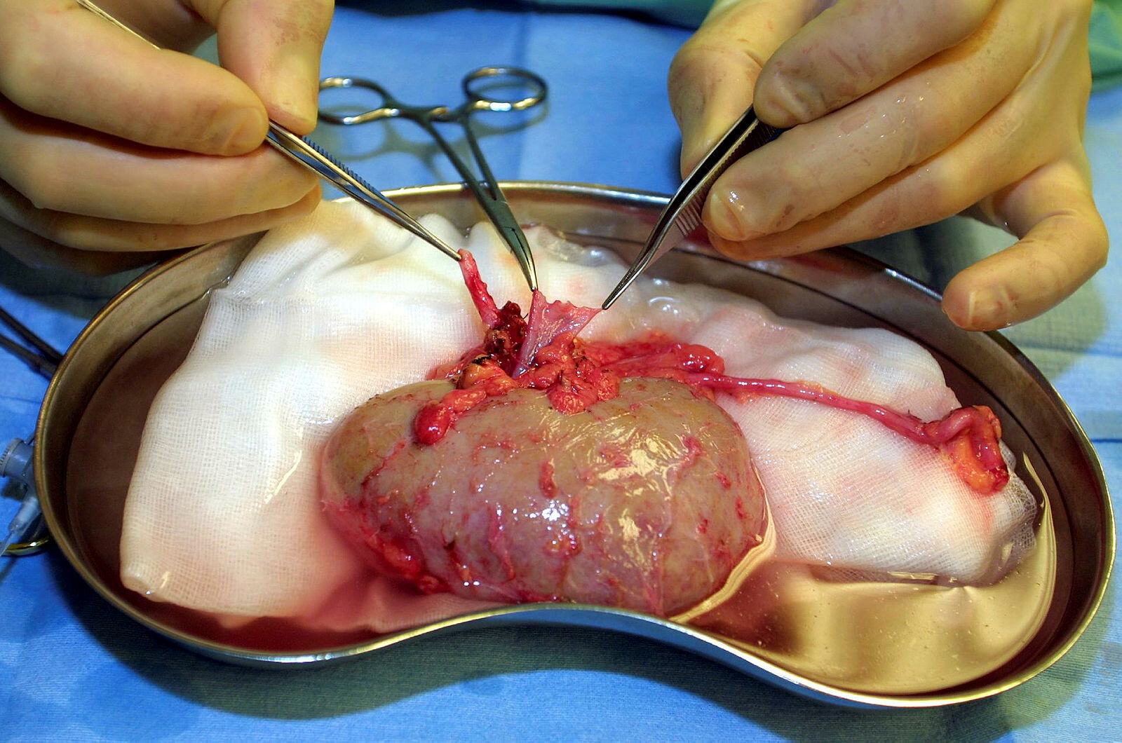 Bildet viser en nyre som er blitt operert ut av en mann. Nyren ligger på et fat, og to hender med instrumenter og saks arbeider.