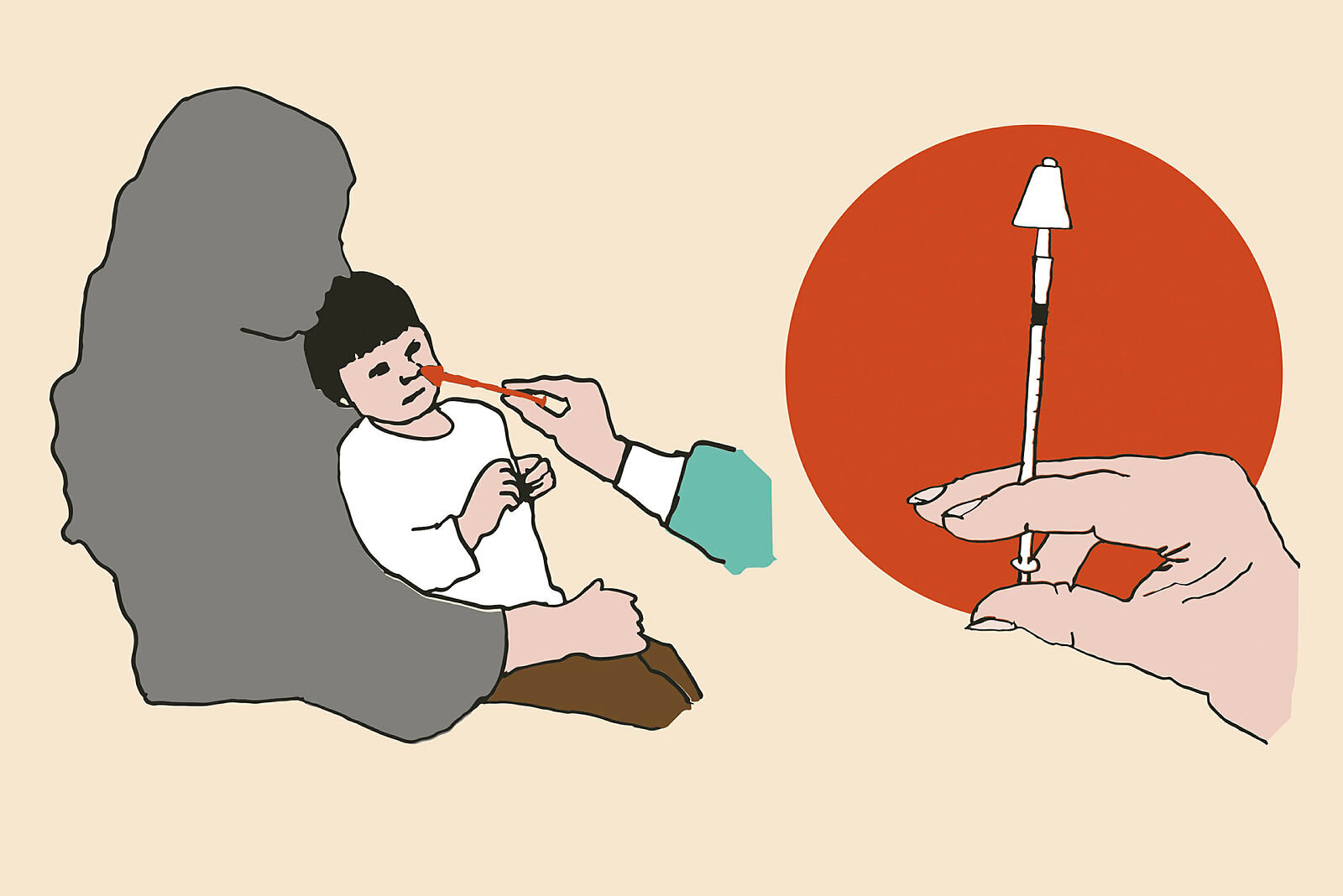 Illustrasjonen viser et barn som sederes med nesespray – intranasal deksmedetomidin – før anestesi. Til høyre ses sprøyten som brukes til administrering av medikamentet.